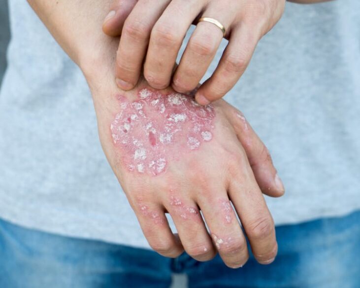 Psoriāze rokās