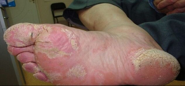 Psoriāze uz kājām