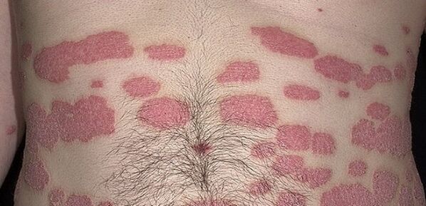 Psoriāze