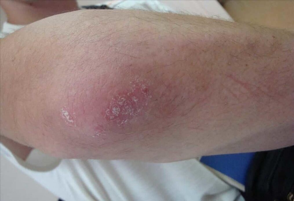Kā izskatās psoriāze