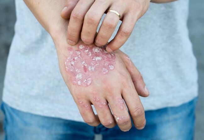 Mesniched psoriāze