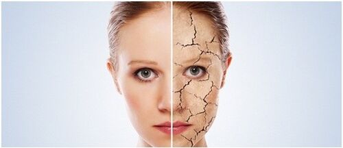 Mēs izturamies pret psoriāzi