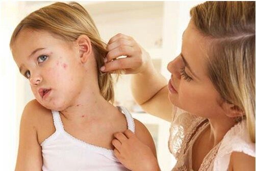 Psoriāze bērniem