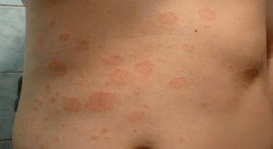 Neveiksmīga psoriāze
