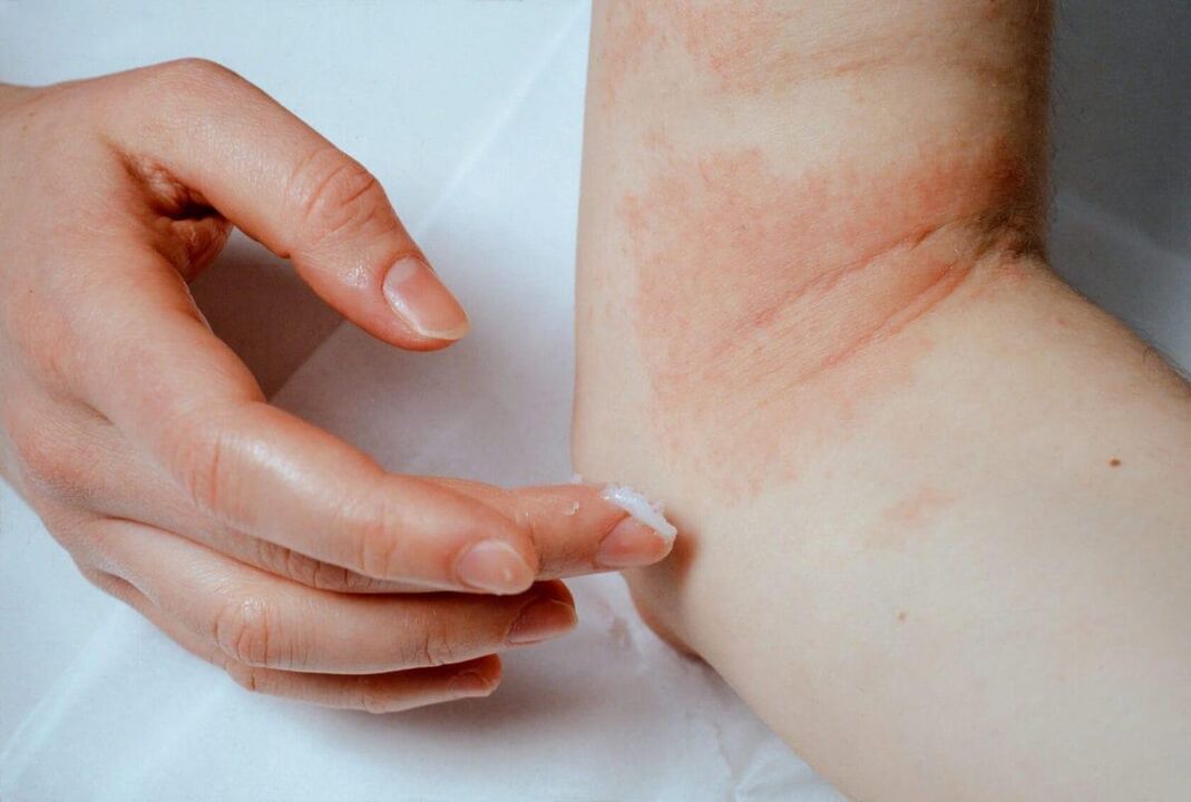 Psoriāzes ārstēšana