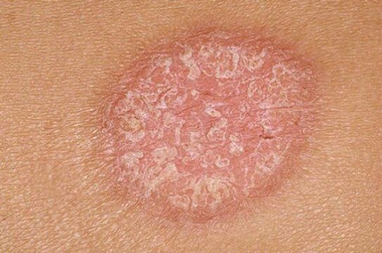psoriāze