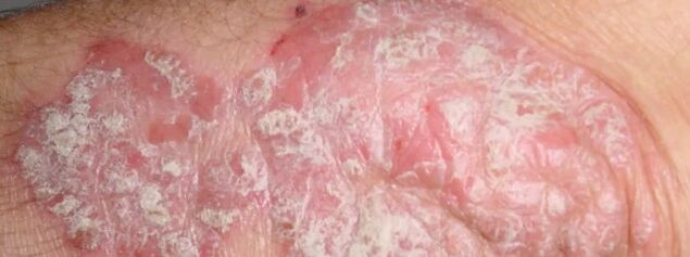 Mesniched psoriāze