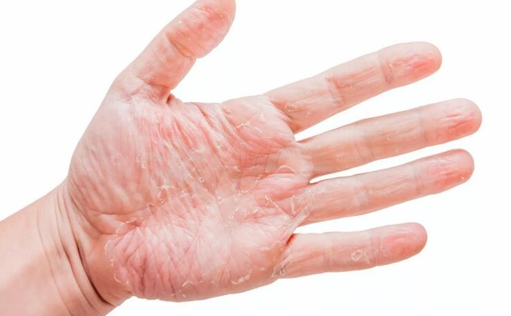 Psoriāze