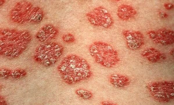 Psoriāzes formas
