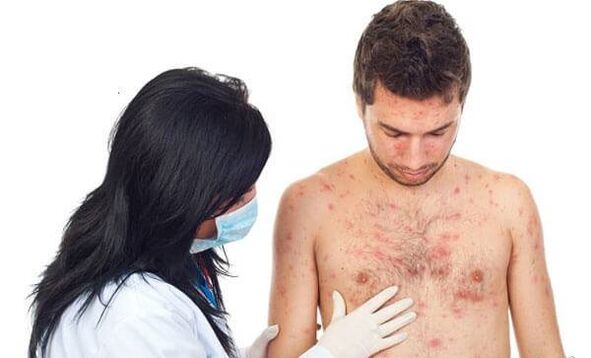 Psoriāzes foto