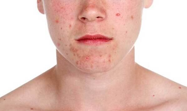 Psoriāzes simptomi