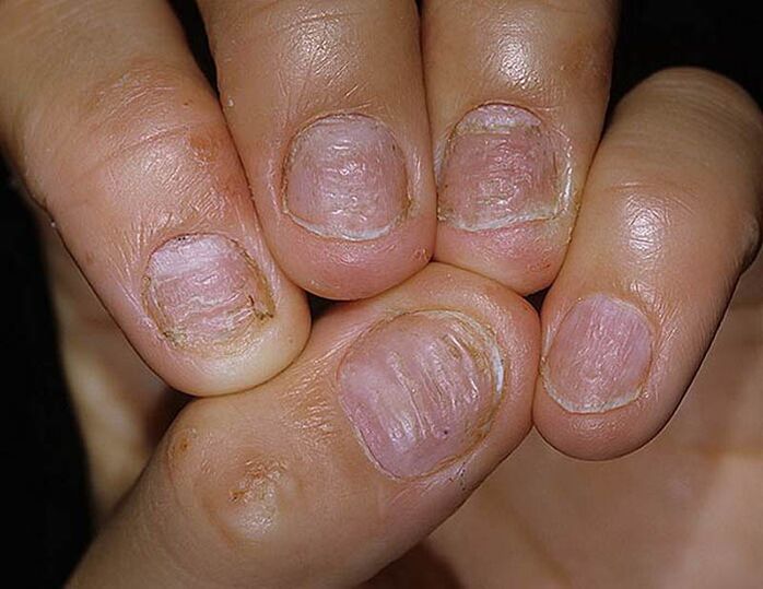 Naglu psoriāze