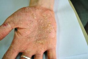 Psoriāze plaukstā