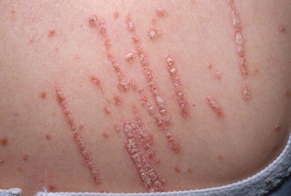 Psoriāze uz ķermeņa