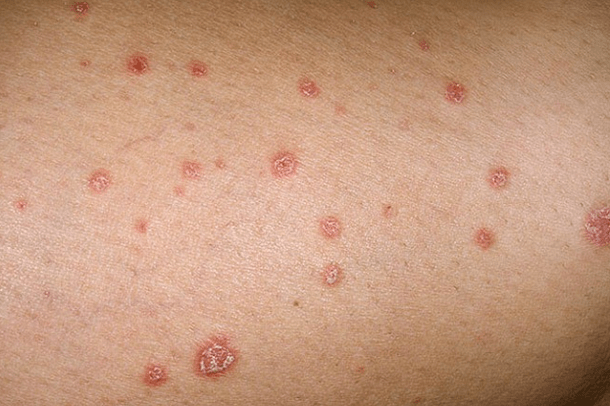 Psoriātiskās plāksnes