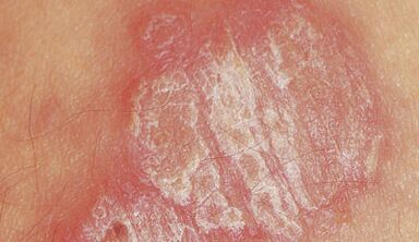 psoriāze