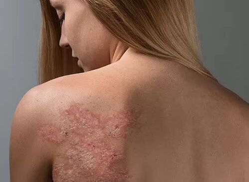 Psoriāze meitenes mugurā
