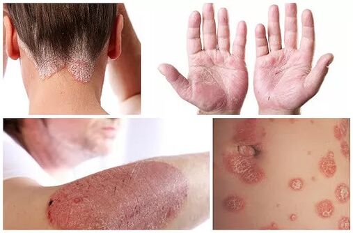 Psoriāzes izpausmes dažādās ķermeņa daļās