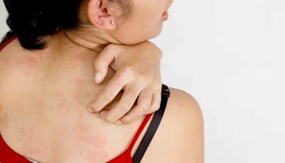 psoriāze