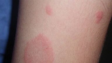 Kā izpaužas psoriāzes sākotnējā stadija