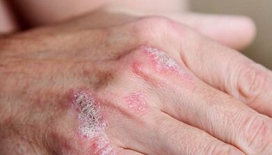 psoriāzes sākotnējās stadijas simptomi