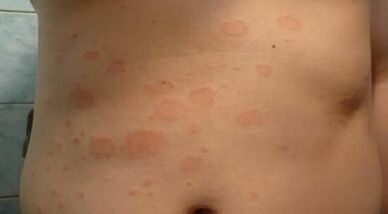 kā atpazīt psoriāzes sākotnējo stadiju