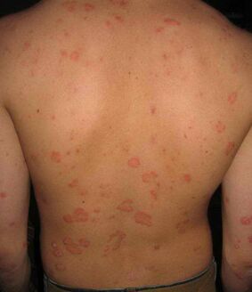 psoriāze uz muguras