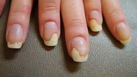 Balti plankumi uz nagiem psoriāzes dēļ