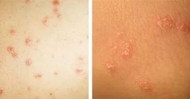 Galvenās psoriāzes izpausmes