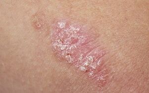 psoriāzes cēloņi