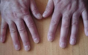 psoriāzes simptomi sākotnējā stadijā