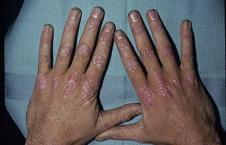 psoriāzes attīstības iemesli uz rokām