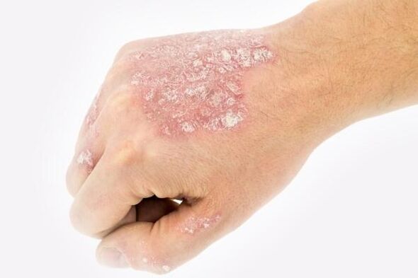 psoriāzes attīstības mehānisms uz rokām