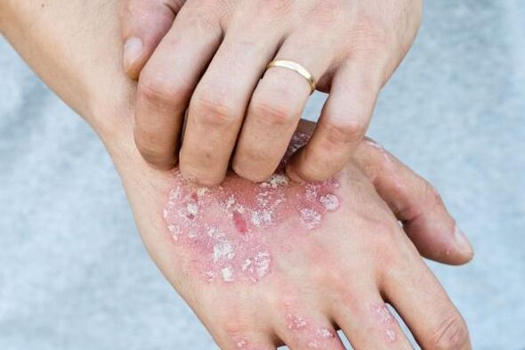 raksturīgi psoriāzes simptomi uz rokām